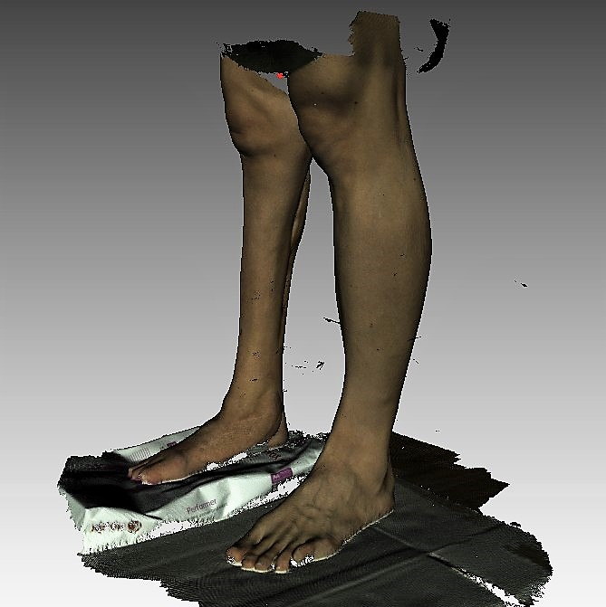 3D-Rohdaten einer Waden-Fehlbildung Artec 3D
